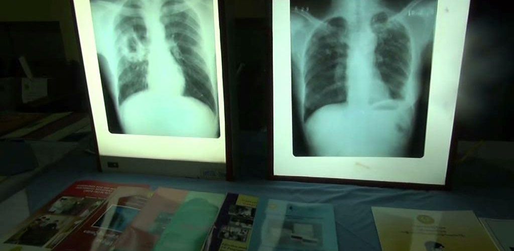 Health Ministry focuses funds on tuberculosis treatment