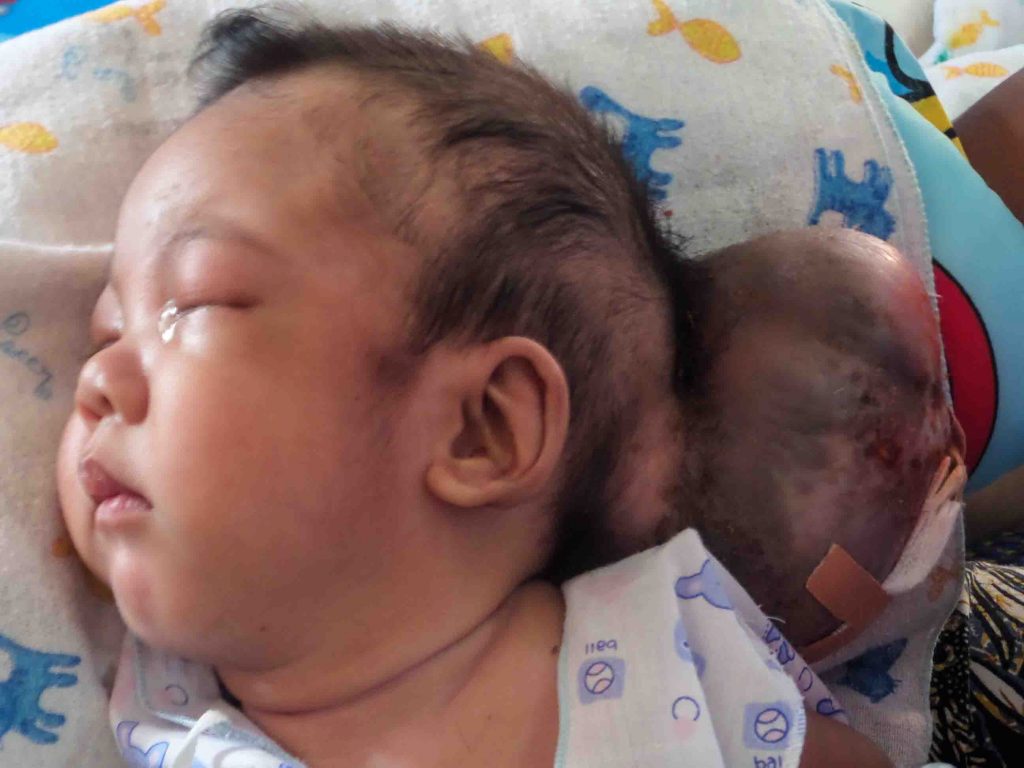 Mon's growth before his operation. (Photo: Burma Children Medical Fund)