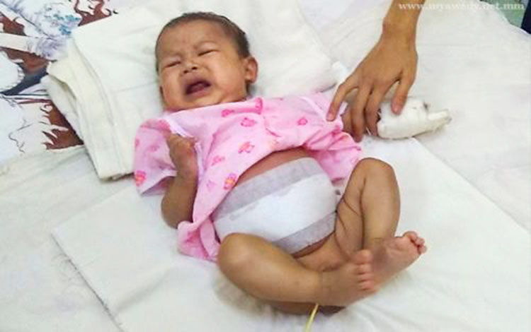 Triplet foetuses removed from baby in Naypyidaw